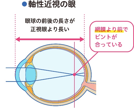 軸性近視の眼