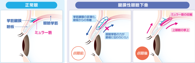 眼瞼下垂の図